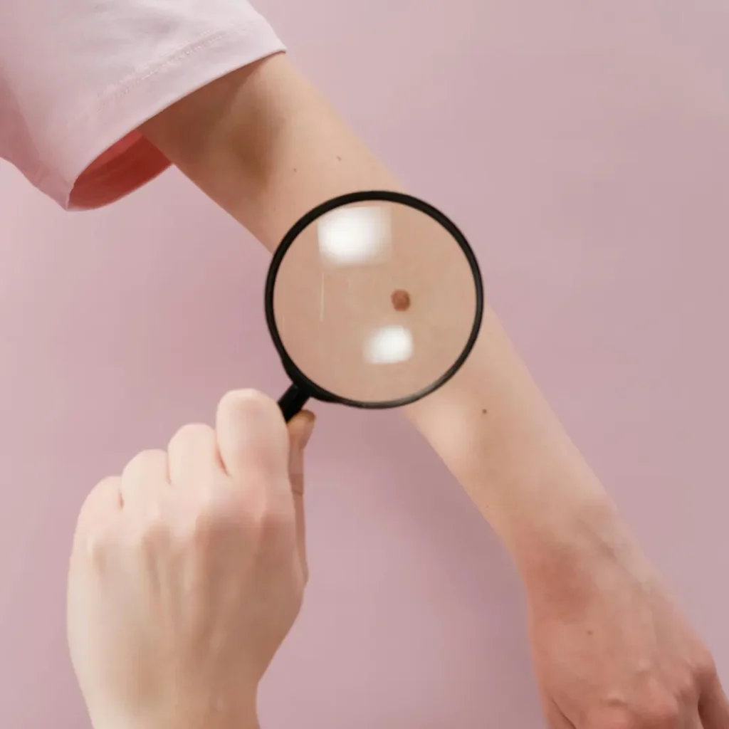 EVANI-HOSPITAL-Dermatology-Mole-Evaluation