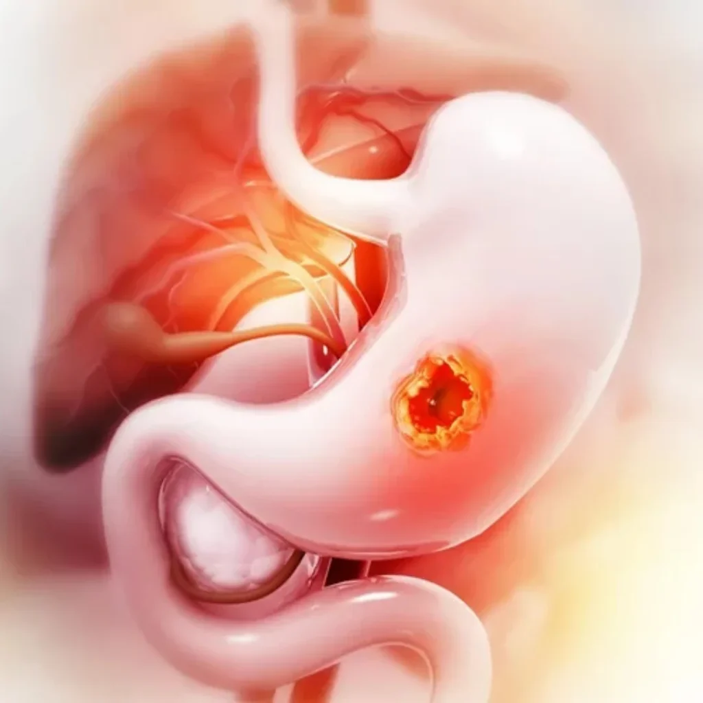 EVANI-HOSPITAL-Gastroenterology-Ulcers-and-Gastrointestinal-Infections