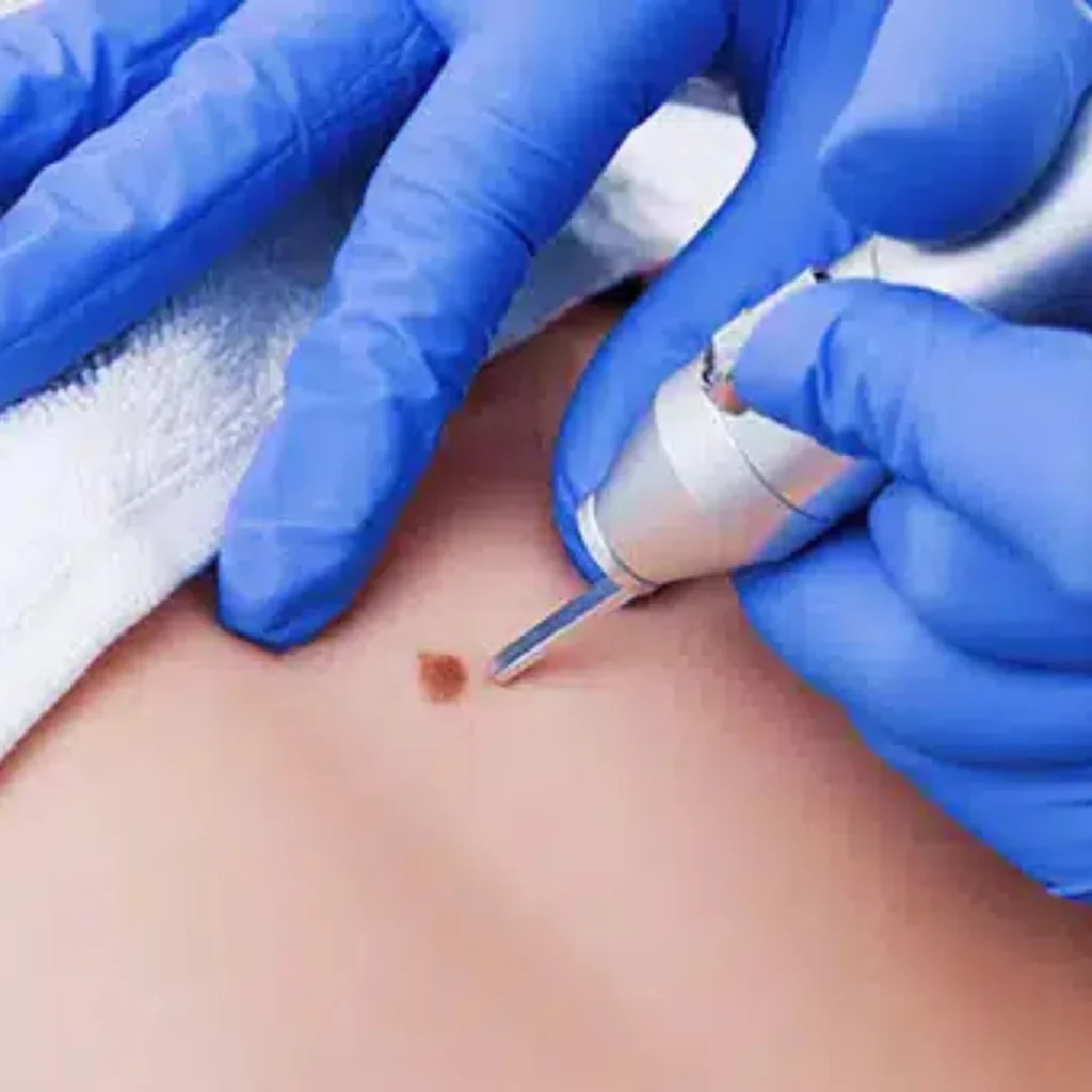 EVANI-HOSPITAL-Plastic-Surgery-Mole-Removal