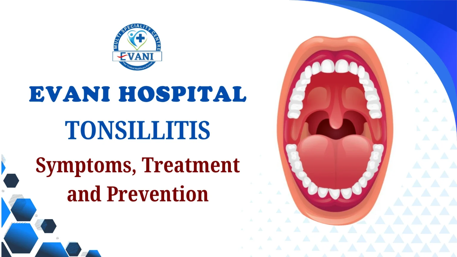 Tonsillitis in Children and Adults Symptoms, Treatment and Prevention